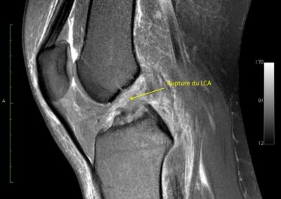 Aspect IRM d'une rupture du LCA