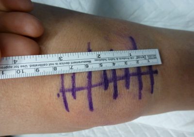 taille cicatrice genou 8cm